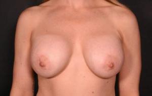 隆胸前移除假体前视图7116例