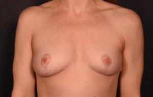 隆胸后移除假体前视图7116例